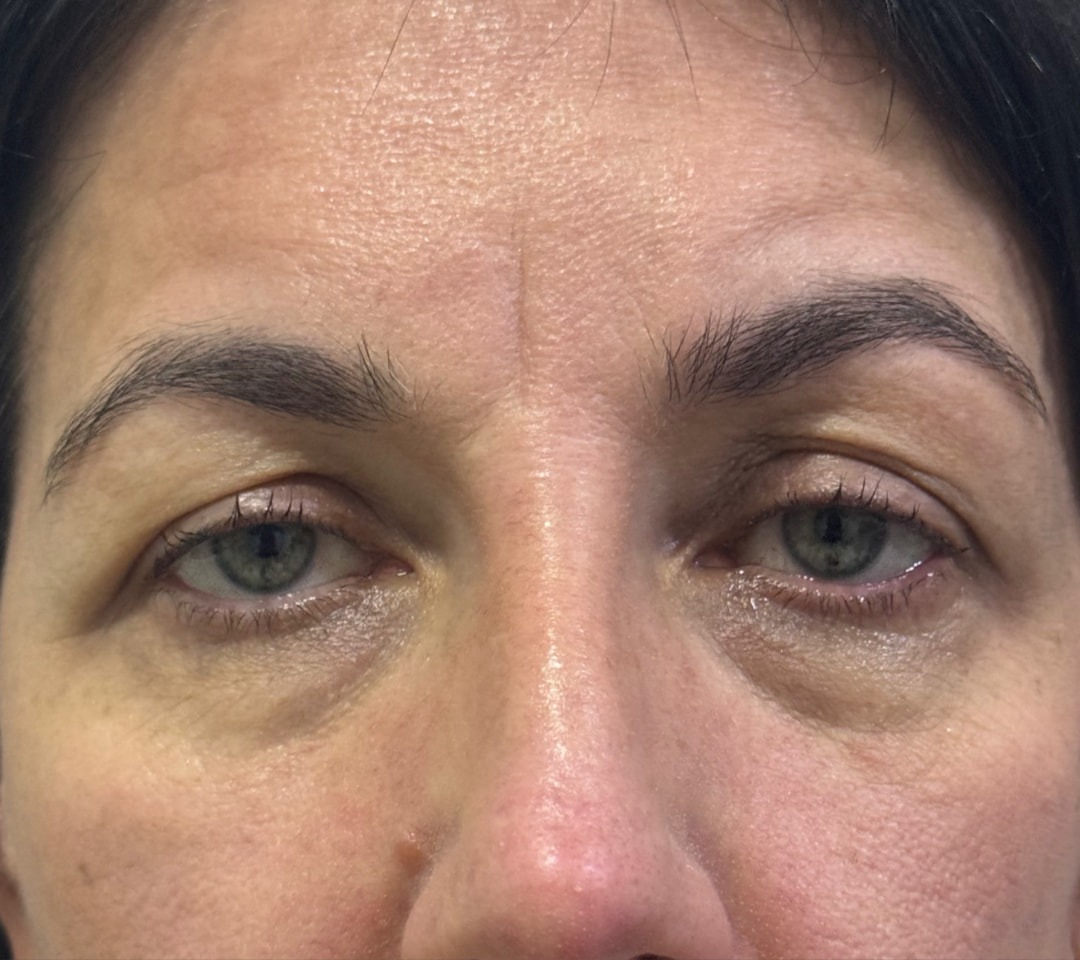 Olhar antes da blefaroplastia