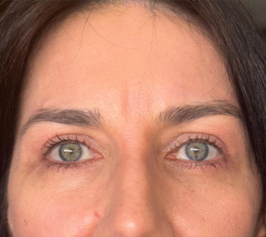 Olhar após a blefaroplastia